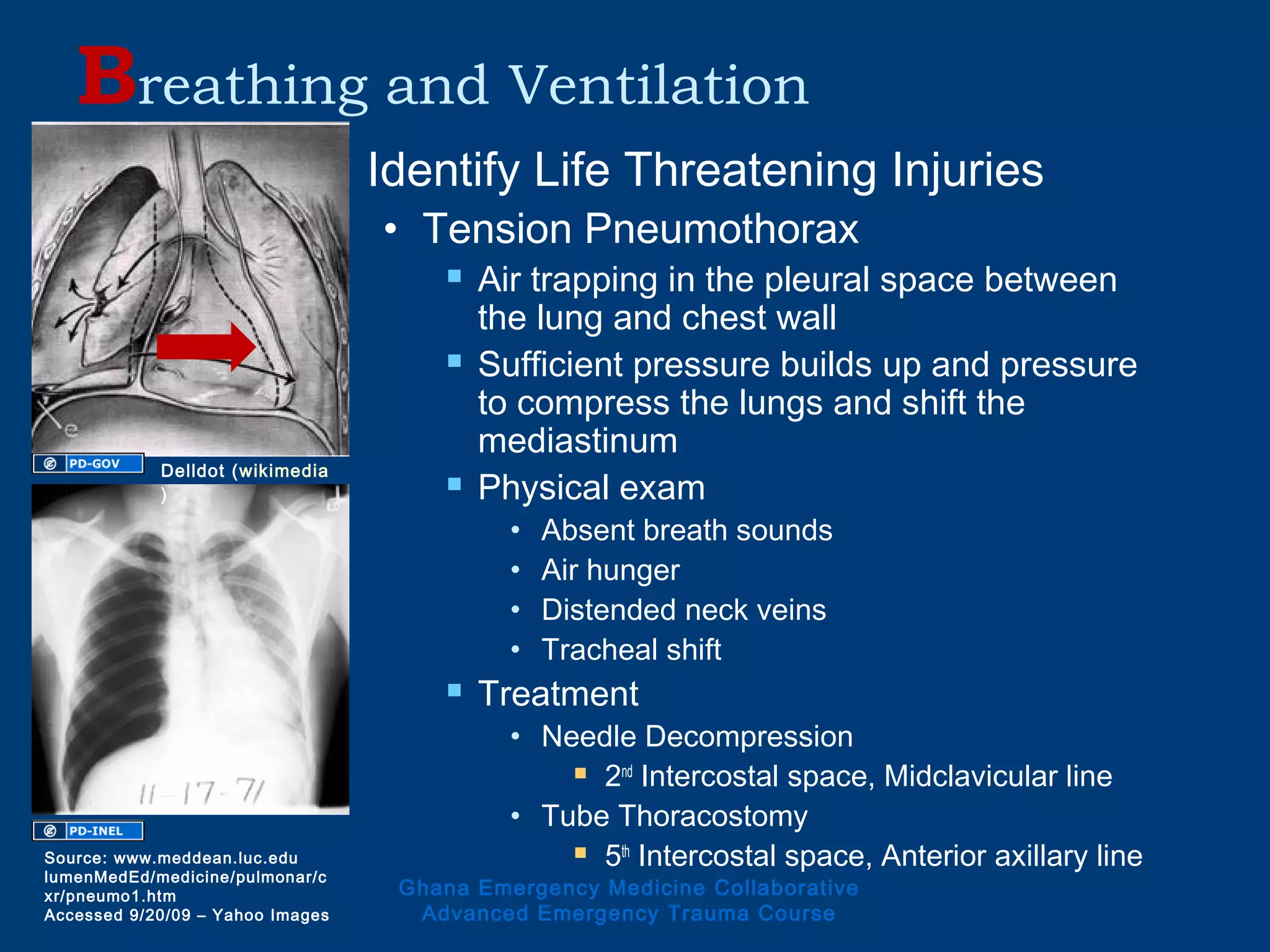  Identify Life Threatening Injuries
• Tension Pneumothorax
 Air trapping in the pleural space between
the lung and chest wall
 Sufficient pressure builds up and pressure
to compress the lungs and shift the
mediastinum
 Physical exam
• Absent breath sounds
• Air hunger
• Distended neck veins
• Tracheal shift
 Treatment
• Needle Decompression
 2nd
Intercostal space, Midclavicular line
• Tube Thoracostomy
 5th
Intercostal space, Anterior axillary line
Breathing and Ventilation
Ghana Emergency Medicine Collaborative
Advanced Emergency Trauma Course
Source: www.meddean.luc.edu
lumenMedEd/medicine/pulmonar/c
xr/pneumo1.htm
Accessed 9/20/09 – Yahoo Images
Delldot (wikimedia
)
 