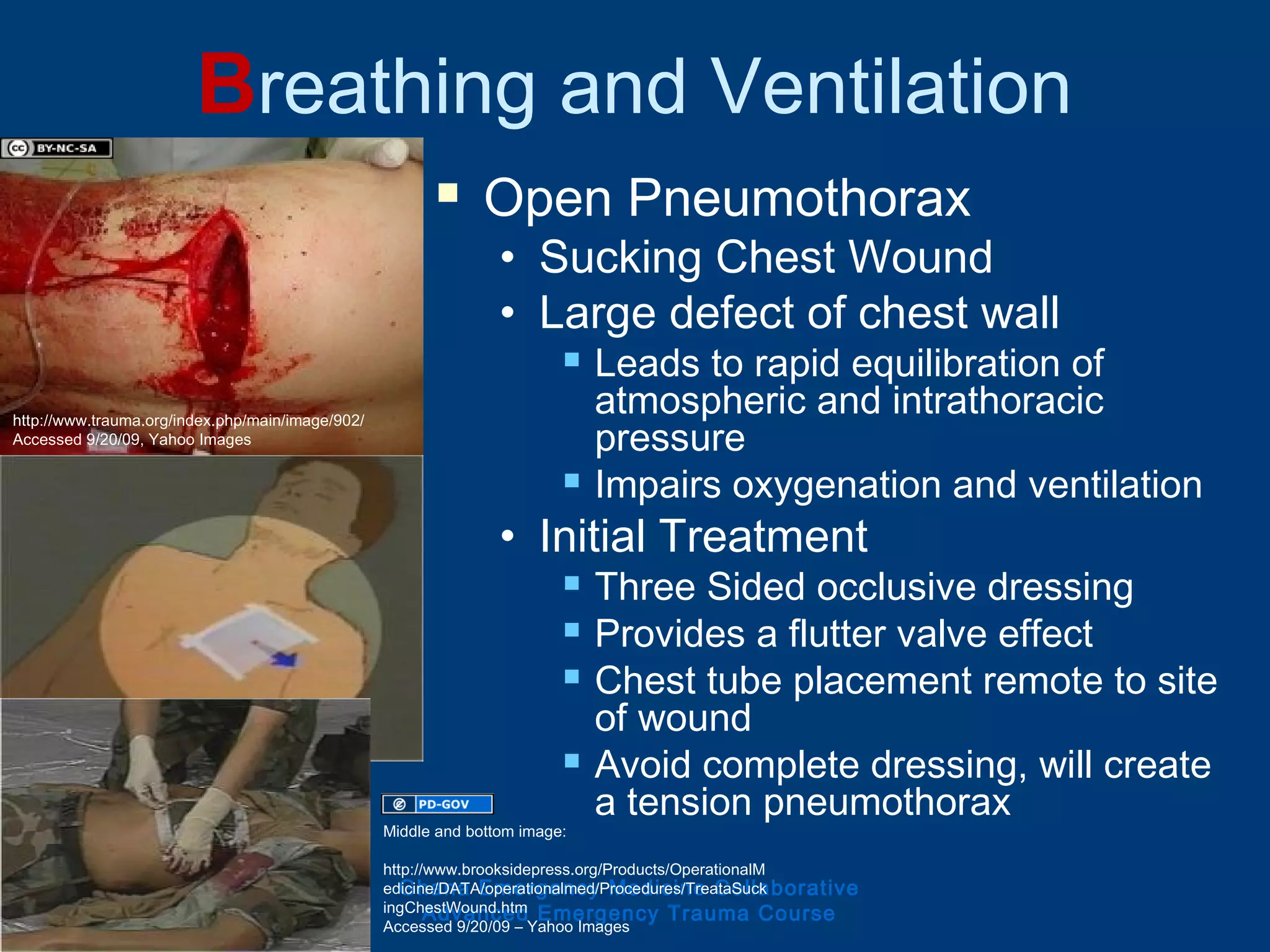 Breathing and Ventilation
 Open Pneumothorax
• Sucking Chest Wound
• Large defect of chest wall
 Leads to rapid equilibration of
atmospheric and intrathoracic
pressure
 Impairs oxygenation and ventilation
• Initial Treatment
 Three Sided occlusive dressing
 Provides a flutter valve effect
 Chest tube placement remote to site
of wound
 Avoid complete dressing, will create
a tension pneumothorax
Ghana Emergency Medicine Collaborative
Advanced Emergency Trauma Course
Middle and bottom image:
http://www.brooksidepress.org/Products/OperationalM
edicine/DATA/operationalmed/Procedures/TreataSuck
ingChestWound.htm
Accessed 9/20/09 – Yahoo Images
http://www.trauma.org/index.php/main/image/902/
Accessed 9/20/09, Yahoo Images
 