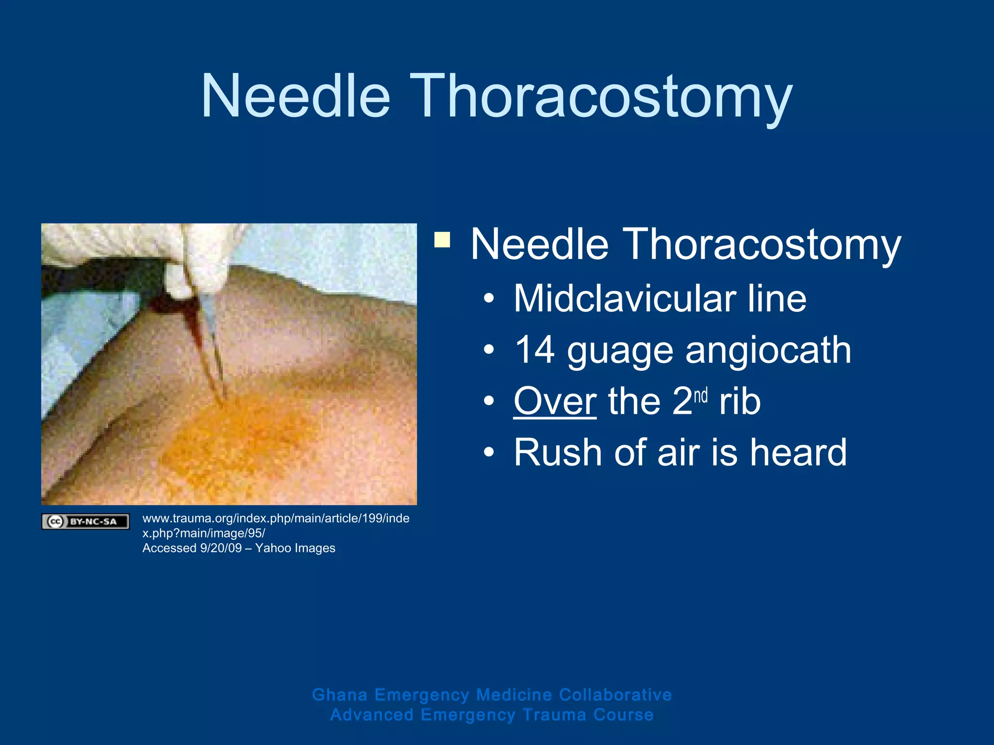 Needle Thoracostomy
 Needle Thoracostomy
• Midclavicular line
• 14 guage angiocath
• Over the 2nd
rib
• Rush of air is heard
Ghana Emergency Medicine Collaborative
Advanced Emergency Trauma Course
www.trauma.org/index.php/main/article/199/inde
x.php?main/image/95/
Accessed 9/20/09 – Yahoo Images
 