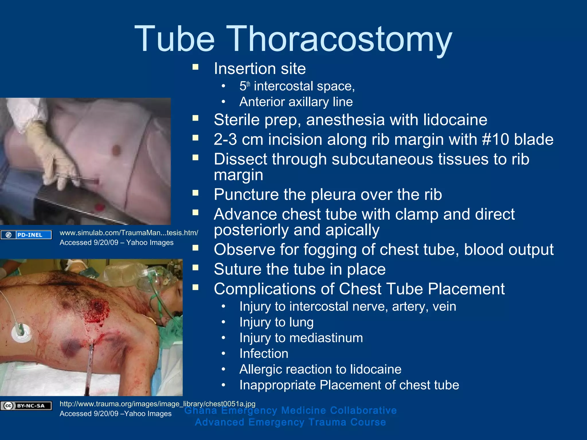 Tube Thoracostomy
 Insertion site
• 5th
intercostal space,
• Anterior axillary line
 Sterile prep, anesthesia with lidocaine
 2-3 cm incision along rib margin with #10 blade
 Dissect through subcutaneous tissues to rib
margin
 Puncture the pleura over the rib
 Advance chest tube with clamp and direct
posteriorly and apically
 Observe for fogging of chest tube, blood output
 Suture the tube in place
 Complications of Chest Tube Placement
• Injury to intercostal nerve, artery, vein
• Injury to lung
• Injury to mediastinum
• Infection
• Allergic reaction to lidocaine
• Inappropriate Placement of chest tube
Ghana Emergency Medicine Collaborative
Advanced Emergency Trauma Course
www.simulab.com/TraumaMan...tesis.htm/
Accessed 9/20/09 – Yahoo Images
http://www.trauma.org/images/image_library/chest0051a.jpg
Accessed 9/20/09 –Yahoo Images
 