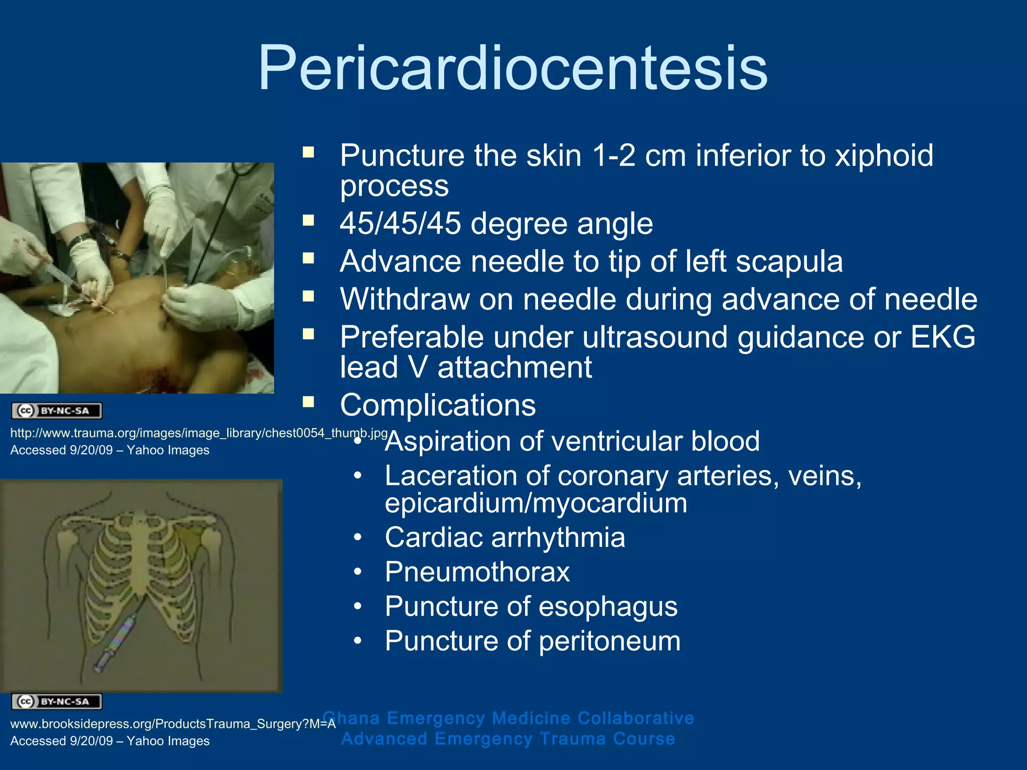 Pericardiocentesis
 Puncture the skin 1-2 cm inferior to xiphoid
process
 45/45/45 degree angle
 Advance needle to tip of left scapula
 Withdraw on needle during advance of needle
 Preferable under ultrasound guidance or EKG
lead V attachment
 Complications
• Aspiration of ventricular blood
• Laceration of coronary arteries, veins,
epicardium/myocardium
• Cardiac arrhythmia
• Pneumothorax
• Puncture of esophagus
• Puncture of peritoneum
Ghana Emergency Medicine Collaborative
Advanced Emergency Trauma Course
http://www.trauma.org/images/image_library/chest0054_thumb.jpg
Accessed 9/20/09 – Yahoo Images
www.brooksidepress.org/ProductsTrauma_Surgery?M=A
Accessed 9/20/09 – Yahoo Images
 