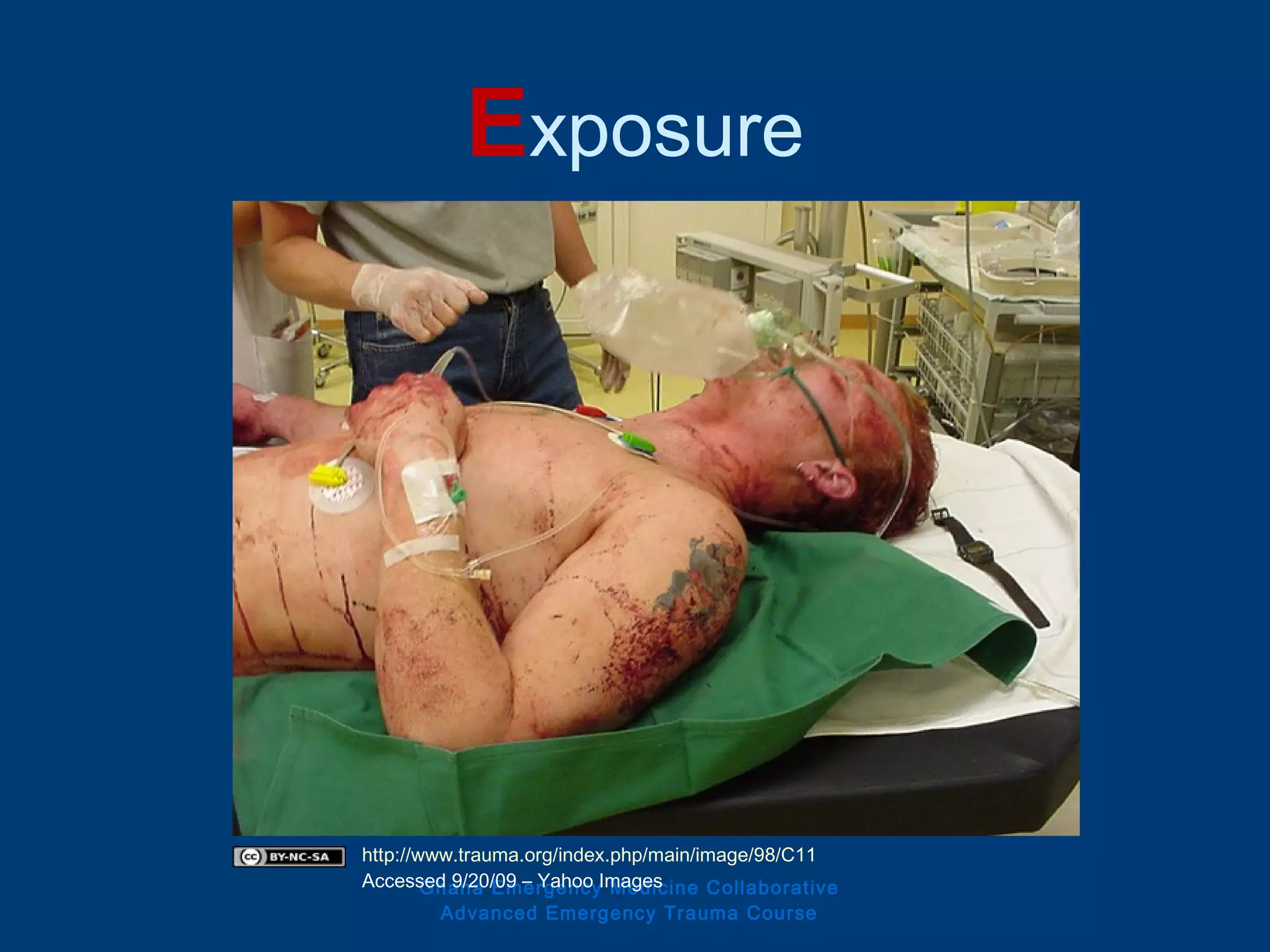 Exposure
Ghana Emergency Medicine Collaborative
Advanced Emergency Trauma Course
http://www.trauma.org/index.php/main/image/98/C11
Accessed 9/20/09 – Yahoo Images
 