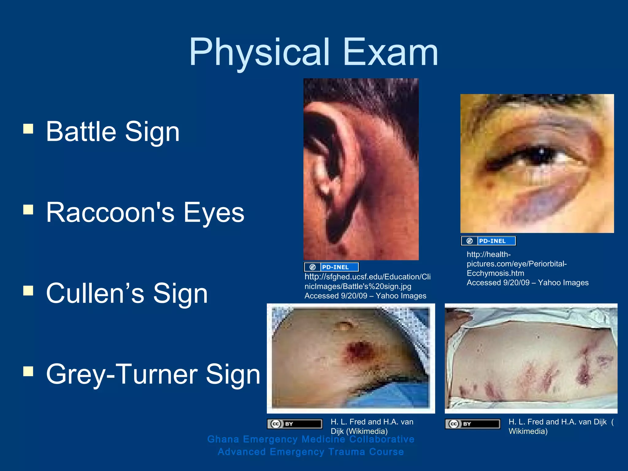 Physical Exam
 Battle Sign
 Raccoon's Eyes
 Cullen’s Sign
 Grey-Turner Sign
Ghana Emergency Medicine Collaborative
Advanced Emergency Trauma Course
http://sfghed.ucsf.edu/Education/Cli
nicImages/Battle's%20sign.jpg
Accessed 9/20/09 – Yahoo Images
http://health-
pictures.com/eye/Periorbital-
Ecchymosis.htm
Accessed 9/20/09 – Yahoo Images
H. L. Fred and H.A. van
Dijk (Wikimedia)
H. L. Fred and H.A. van Dijk (
Wikimedia)
 