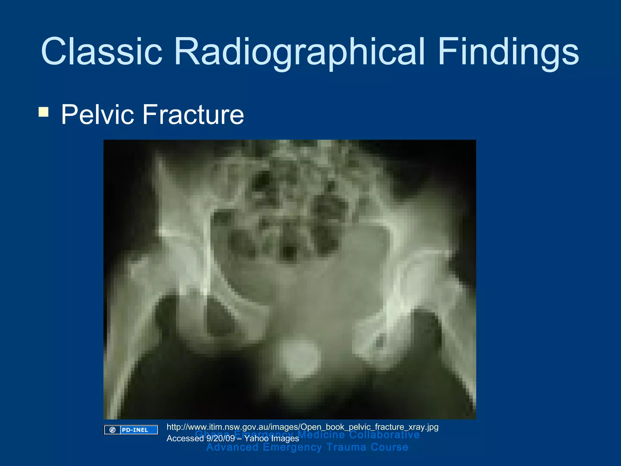 Classic Radiographical Findings
 Pelvic Fracture
Ghana Emergency Medicine Collaborative
Advanced Emergency Trauma Course
http://www.itim.nsw.gov.au/images/Open_book_pelvic_fracture_xray.jpg
Accessed 9/20/09 – Yahoo Images
 