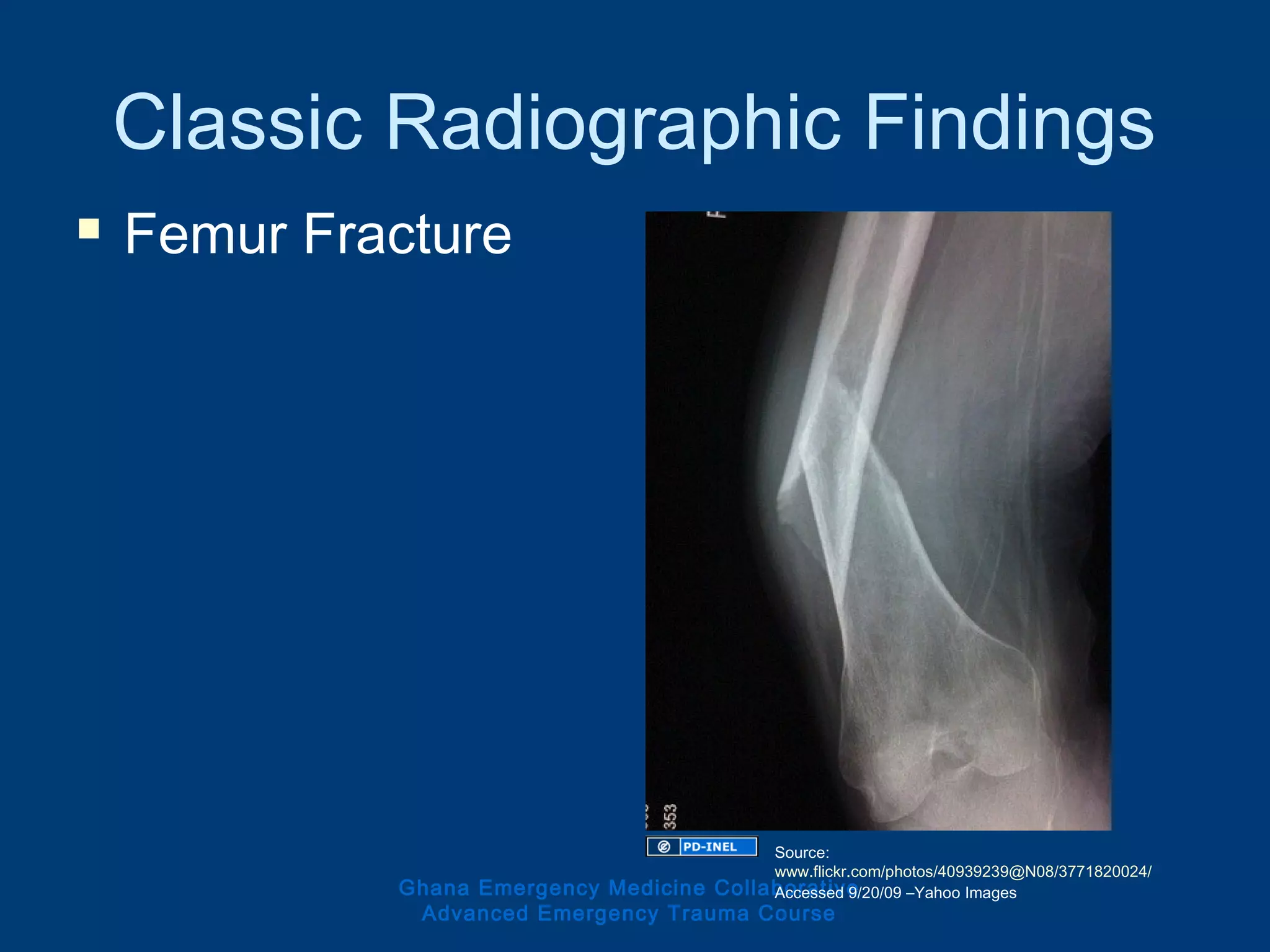 Classic Radiographic Findings
 Femur Fracture
Ghana Emergency Medicine Collaborative
Advanced Emergency Trauma Course
Source:
www.flickr.com/photos/40939239@N08/3771820024/
Accessed 9/20/09 –Yahoo Images
 