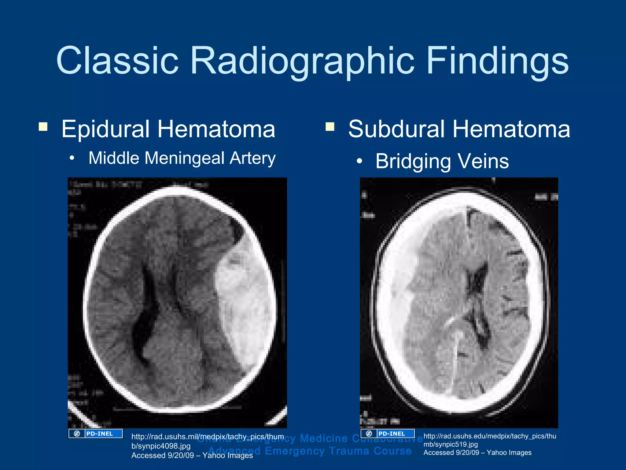 Classic Radiographic Findings
 Epidural Hematoma
• Middle Meningeal Artery
 Subdural Hematoma
• Bridging Veins
Ghana Emergency Medicine Collaborative
Advanced Emergency Trauma Course
http://rad.usuhs.mil/medpix/tachy_pics/thum
b/synpic4098.jpg
Accessed 9/20/09 – Yahoo Images
http://rad.usuhs.edu/medpix/tachy_pics/thu
mb/synpic519.jpg
Accessed 9/20/09 – Yahoo Images
 