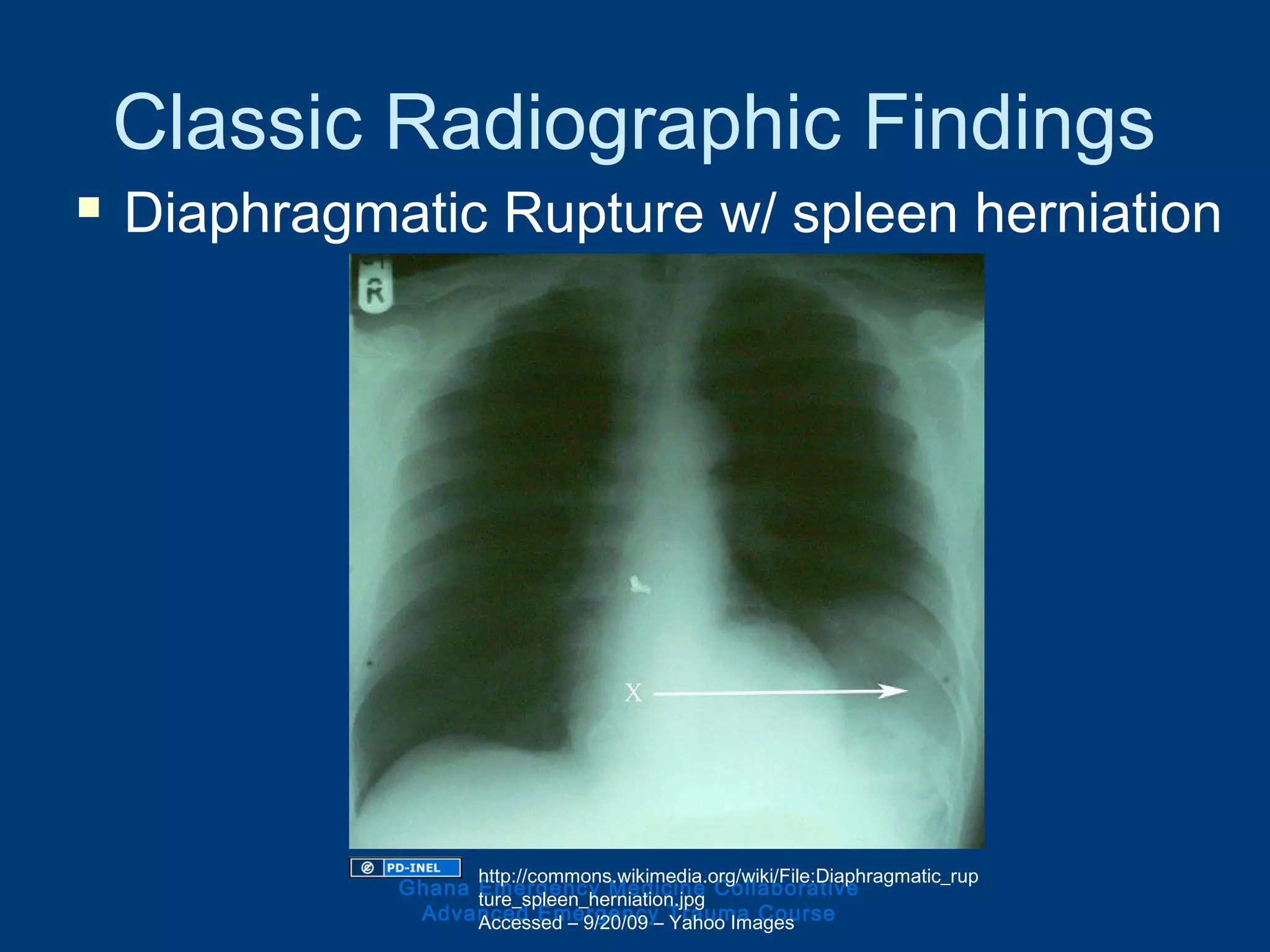 Classic Radiographic Findings
 Diaphragmatic Rupture w/ spleen herniation
Ghana Emergency Medicine Collaborative
Advanced Emergency Trauma Course
http://commons.wikimedia.org/wiki/File:Diaphragmatic_rup
ture_spleen_herniation.jpg
Accessed – 9/20/09 – Yahoo Images
 