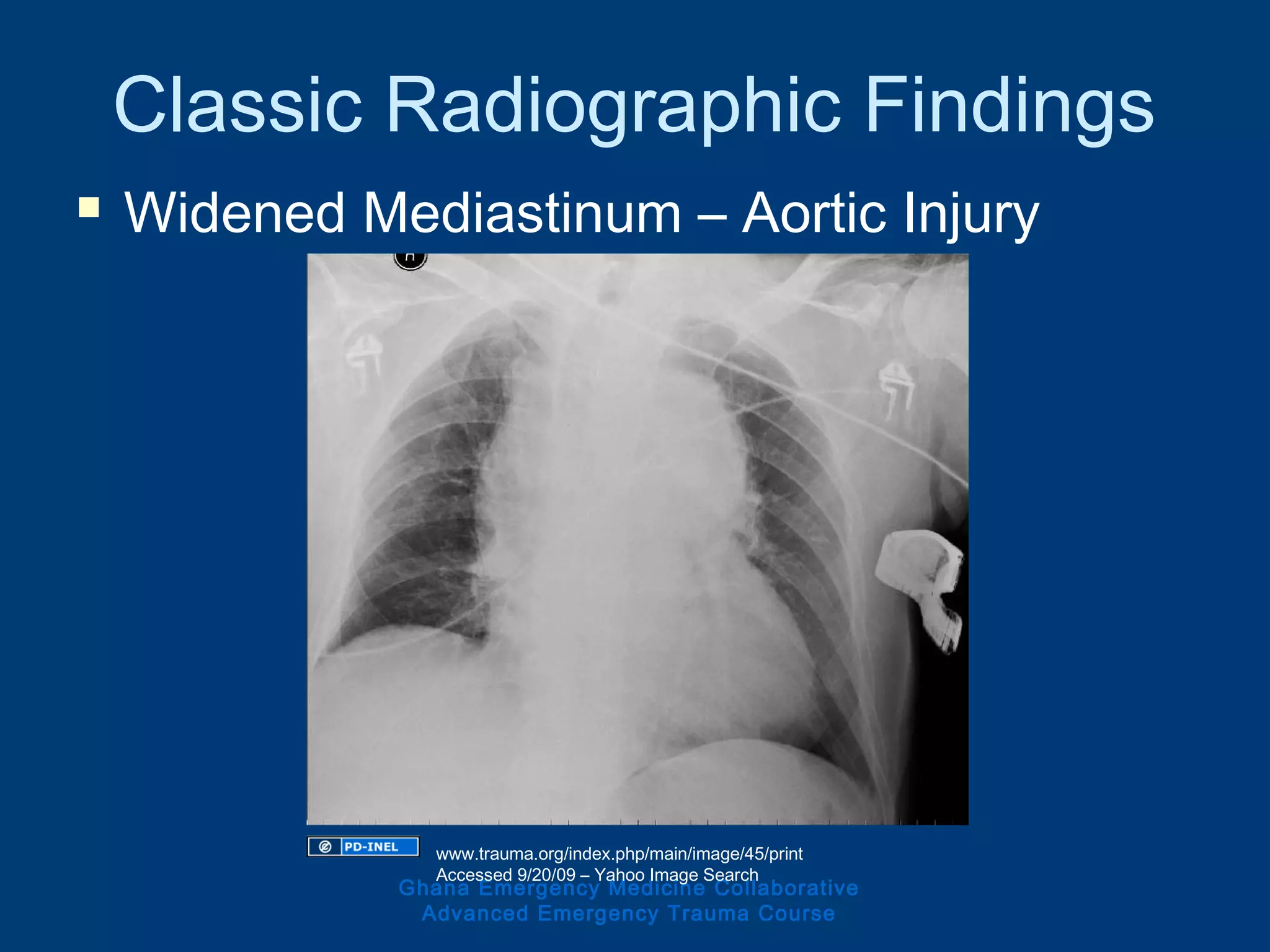 Classic Radiographic Findings
 Widened Mediastinum – Aortic Injury
Ghana Emergency Medicine Collaborative
Advanced Emergency Trauma Course
www.trauma.org/index.php/main/image/45/print
Accessed 9/20/09 – Yahoo Image Search
 