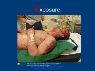 Exposure
Ghana Emergency Medicine Collaborative
Advanced Emergency Trauma Course
http://www.trauma.org/index.php/main/image/98/C11
Accessed 9/20/09 – Yahoo Images
 