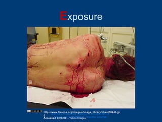 Exposure
Ghana Emergency Medicine Collaborative
Advanced Emergency Trauma Course
http://www.trauma.org/images/image_library/chest0044b.jp
g
Accessed 9/20/09 – Yahoo Images
 