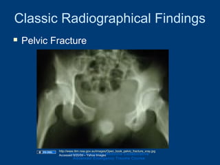 Classic Radiographical Findings
 Pelvic Fracture
Ghana Emergency Medicine Collaborative
Advanced Emergency Trauma Course
http://www.itim.nsw.gov.au/images/Open_book_pelvic_fracture_xray.jpg
Accessed 9/20/09 – Yahoo Images
 