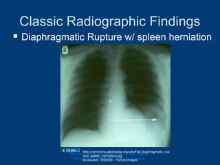 Classic Radiographic Findings
 Diaphragmatic Rupture w/ spleen herniation
Ghana Emergency Medicine Collaborative
Advanced Emergency Trauma Course
http://commons.wikimedia.org/wiki/File:Diaphragmatic_rup
ture_spleen_herniation.jpg
Accessed – 9/20/09 – Yahoo Images
 
