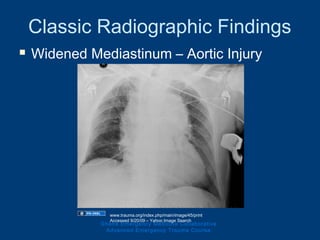Classic Radiographic Findings
 Widened Mediastinum – Aortic Injury
Ghana Emergency Medicine Collaborative
Advanced Emergency Trauma Course
www.trauma.org/index.php/main/image/45/print
Accessed 9/20/09 – Yahoo Image Search
 