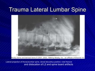 Trauma Lateral Lumbar SpineTrauma Lateral Lumbar Spine
Lateral projection of thoracolumbar spine, dorsal decubitus position; note fracture
and dislocation of L2 and spine board artifacts
 