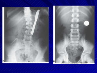 Sharp Force Trauma Radiograph Trauma radiograph | PPTX
