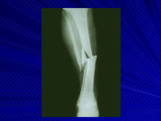Sharp Force Trauma Radiograph Trauma radiograph | PPTX