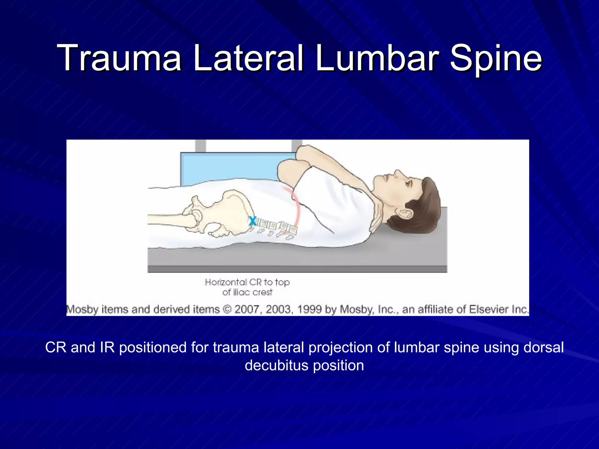 Trauma Lateral Lumbar Spine CR and IR positioned for trauma lateral projection of lumbar spine using dorsal decubitus position 