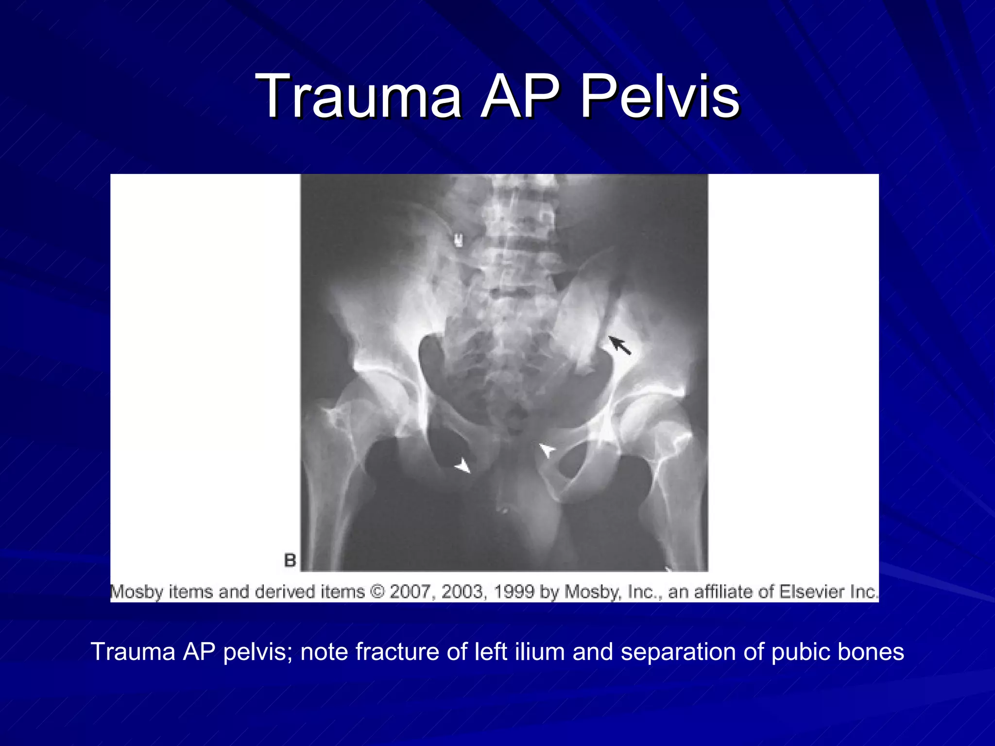 Trauma AP Pelvis Trauma AP pelvis; note fracture of left ilium and separation of pubic bones 