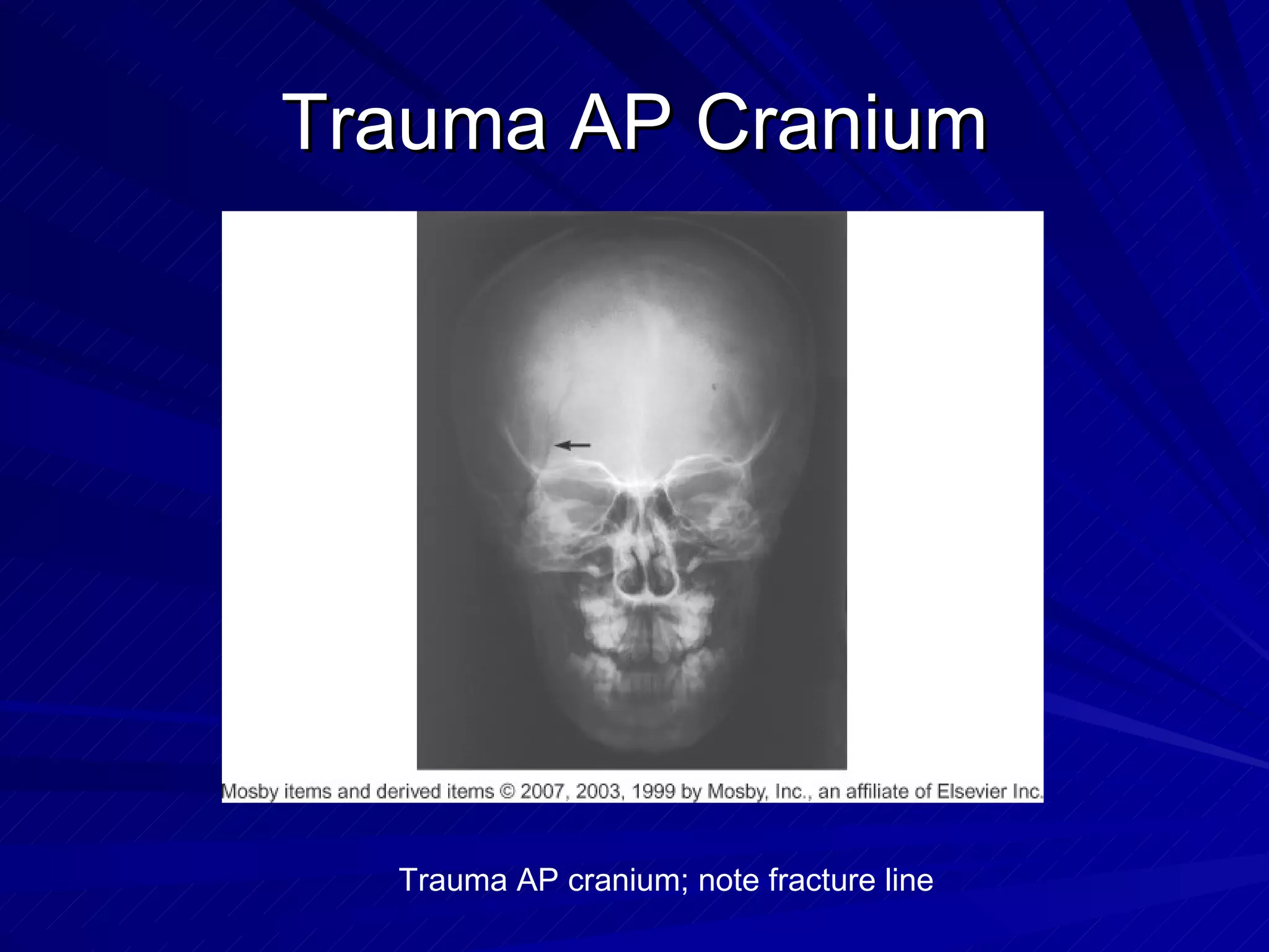 Trauma AP Cranium Trauma AP cranium; note fracture line 