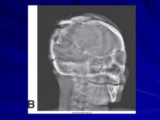 Sharp Force Trauma Radiograph Trauma Radiography | PPT