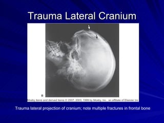 Trauma Lateral Cranium Trauma lateral projection of cranium; note multiple fractures in frontal bone 
