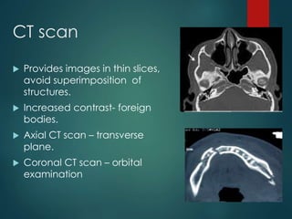 CT scan
 Provides images in thin slices,
avoid superimposition of
structures.
 Increased contrast- foreign
bodies.
 Axial CT scan – transverse
plane.
 Coronal CT scan – orbital
examination
 