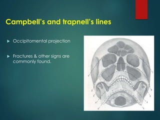  Occipitomental projection
 Fractures & other signs are
commonly found.
Campbell’s and trapnell’s lines
 