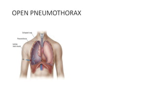 OPEN PNEUMOTHORAX
 