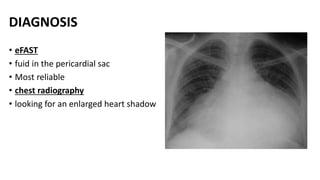 DIAGNOSIS
• eFAST
• fuid in the pericardial sac
• Most reliable
• chest radiography
• looking for an enlarged heart shadow
 