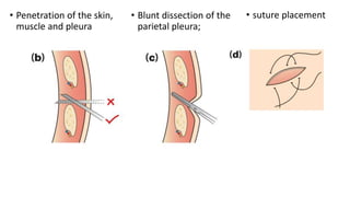 • Penetration of the skin,
muscle and pleura
• Blunt dissection of the
parietal pleura;
• suture placement
 