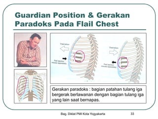 Bag. Diklat PMI Kota Yogyakarta 33
Guardian Position & Gerakan
Paradoks Pada Flail Chest
Gerakan paradoks : bagian patahan tulang iga
bergerak berlawanan dengan bagian tulang iga
yang lain saat bernapas.
 