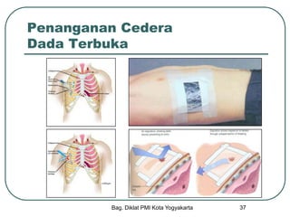 Bag. Diklat PMI Kota Yogyakarta 37
Penanganan Cedera
Dada Terbuka
 