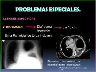LESIONES ESPECÍFICAS
Diafragma
izquierdo
5 a 10 cm
En la Rx inicial de tórax incluyen:
Elevación o borramiento del
hemidiafragma , hemotórax.
Medicina Intensiva. Dr. Carlos Lovesio.
ATLS
 