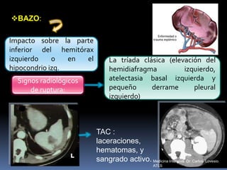 BAZO:
Impacto sobre la parte
inferior del hemitórax
izquierdo o en el
hipocondrio izq.
Signos radiológicos
de ruptura:
La tríada clásica (elevación del
hemidiafragma izquierdo,
atelectasia basal izquierda y
pequeño derrame pleural
izquierdo)
TAC :
laceraciones,
hematomas, y
sangrado activo. Medicina Intensiva. Dr. Carlos Lovesio.
ATLS
 