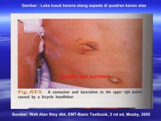(judulin dan sumber) Gambar : Luka tusuk karena stang sepeda di quadran kanan atas  Sumber: Walt Alan Stoy dkk, EMT-Basic Textbook, 2 nd ed, Mosby, 2005 