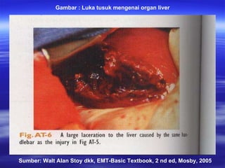 Sumber: Walt Alan Stoy dkk, EMT-Basic Textbook, 2 nd ed, Mosby, 2005 Gambar : Luka tusuk mengenai organ liver  
