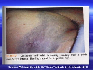 Sumber: Walt Alan Stoy dkk, EMT-Basic Textbook, 2 nd ed, Mosby, 2005 