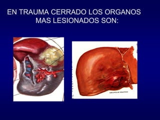 EN TRAUMA CERRADO LOS ORGANOS
MAS LESIONADOS SON:

 