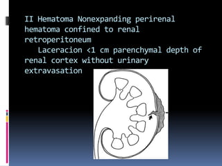 II Hematoma Nonexpanding perirenal
hematoma confined to renal
retroperitoneum
   Laceracion <1 cm parenchymal depth of
ren...