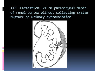 III Laceration <1 cm parenchymal depth
of renal cortex without collecting system
rupture or urinary extravasation
 