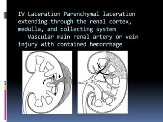 IV Laceration Parenchymal laceration
extending through the renal cortex,
medulla, and collecting system
   Vascular main renal artery or vein
injury with contained hemorrhage
 