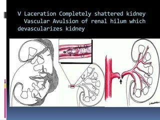 V Laceration Completely shattered kidney
  Vascular Avulsion of renal hilum which
devascularizes kidney
 