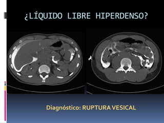 ¿LÍQUIDO LIBRE HIPERDENSO?




    Diagnóstico: RUPTURA VESICAL
 