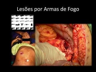 Lesões por Armas de Fogo 
 