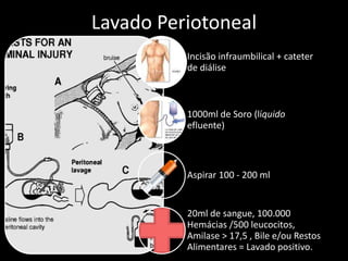 Lavado Periotoneal 
Incisão infraumbilical + cateter 
de diálise 
1000ml de Soro (líquido 
efluente) 
Aspirar 100 - 200 ml 
20ml de sangue, 100.000 
Hemácias /500 leucocitos, 
Amilase > 17,5 , Bile e/ou Restos 
Alimentares = Lavado positivo. 
 