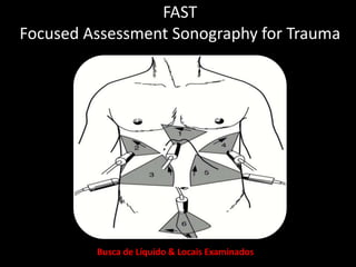 FAST 
Focused Assessment Sonography for Trauma 
Busca de Líquido & Locais Examinados: 
 