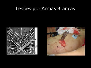 Lesões por Armas Brancas 
 