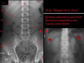 A) 13 – Margem do m. psoas
B) Setas indicando ar perirrenal
Retropneumoperitônio pós-
trauma contundente
A B
 