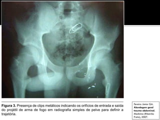 Pereira Júnior GA.
Abordagem geral
trauma abdominal.
Medicina (Ribeirão
Preto), 2007.
 