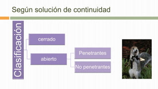 Según solución de continuidad
 